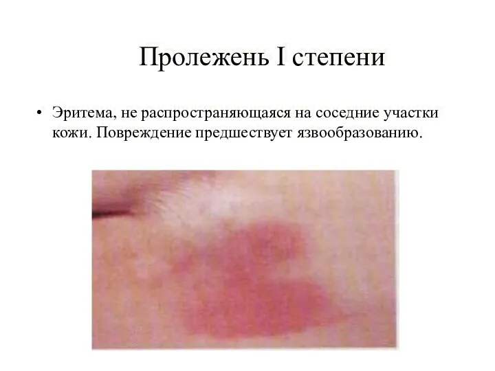 Пролежень I степени Эритема, не распространяющаяся на соседние участки кожи. Повреждение предшествует язвообразованию.