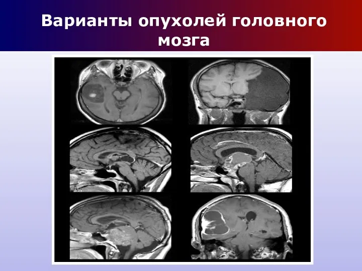 Варианты опухолей головного мозга