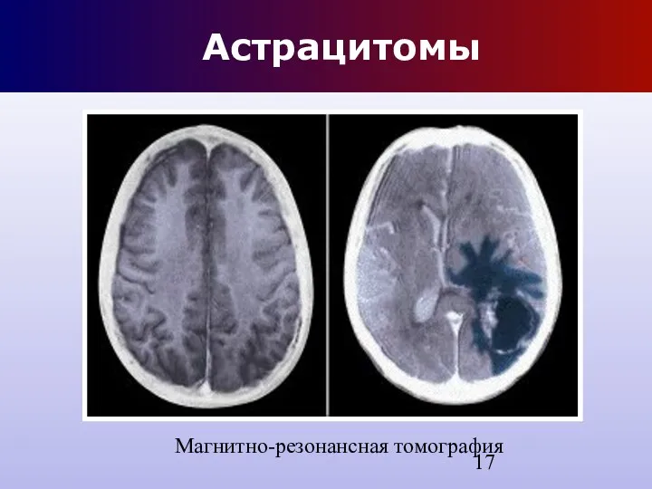 Астрацитомы Магнитно-резонансная томография