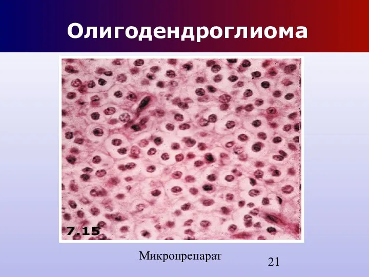 Олигодендроглиома Микропрепарат