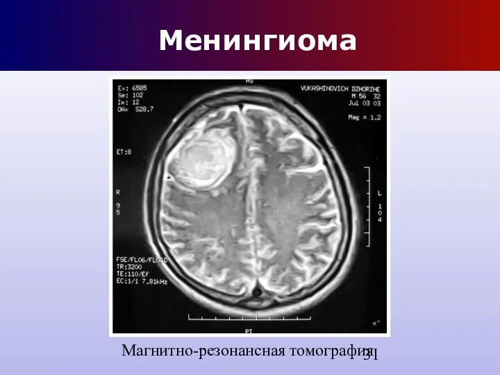Менингиома Магнитно-резонансная томография