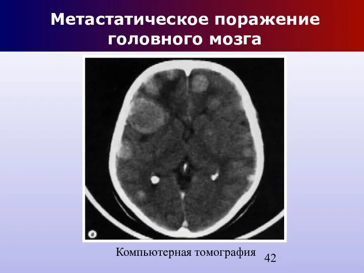 Метастатическое поражение головного мозга Компьютерная томография