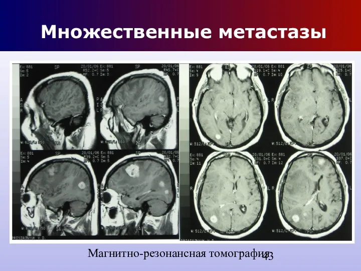 Множественные метастазы Магнитно-резонансная томография