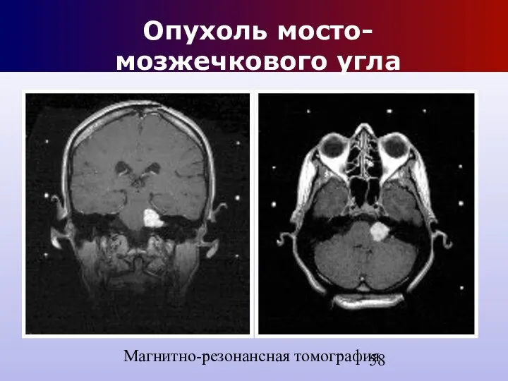 Опухоль мосто-мозжечкового угла Магнитно-резонансная томография