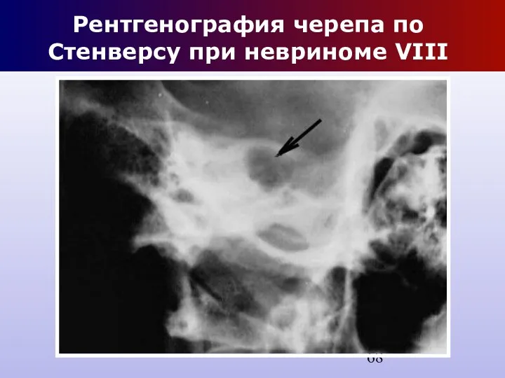 Рентгенография черепа по Стенверсу при невриноме VIII