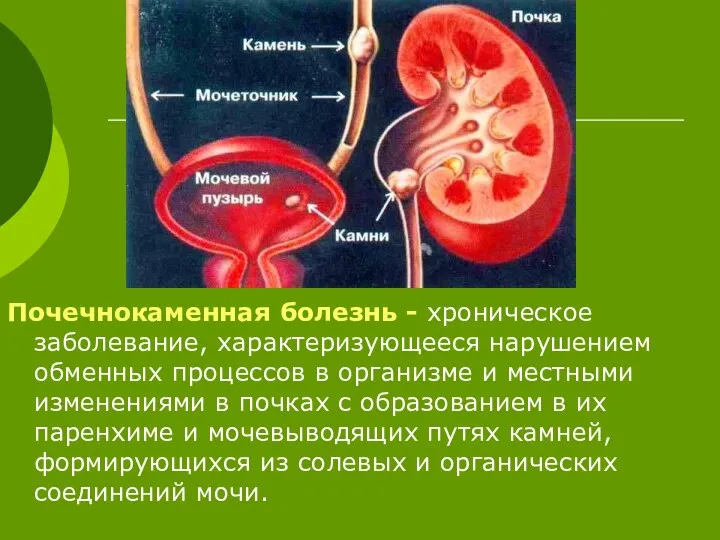 Почечнокаменная болезнь - хроническое заболевание, характеризующееся нарушением обменных процессов в