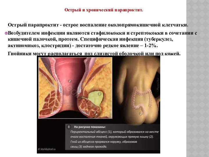 Острый и хронический парапроктит. Острый парапроктит - острое воспаление околопрямокишечной