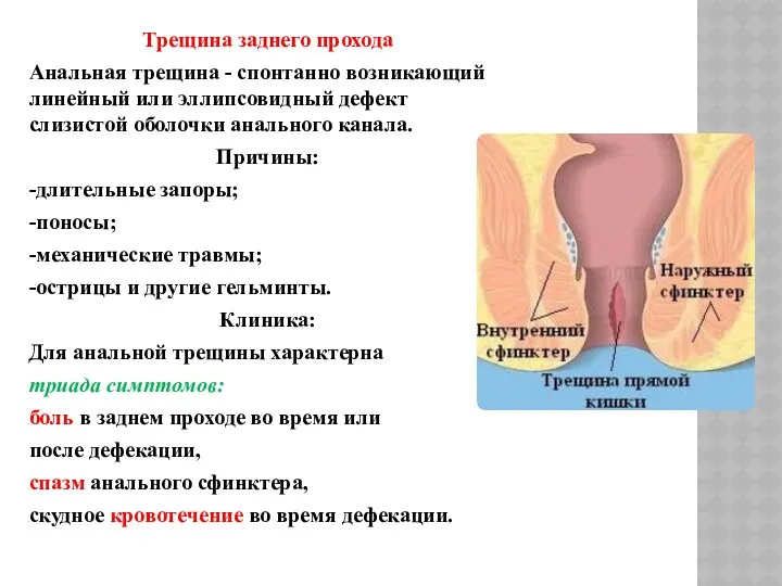 Трещина заднего прохода Анальная трещина - спонтанно возникающий линейный или