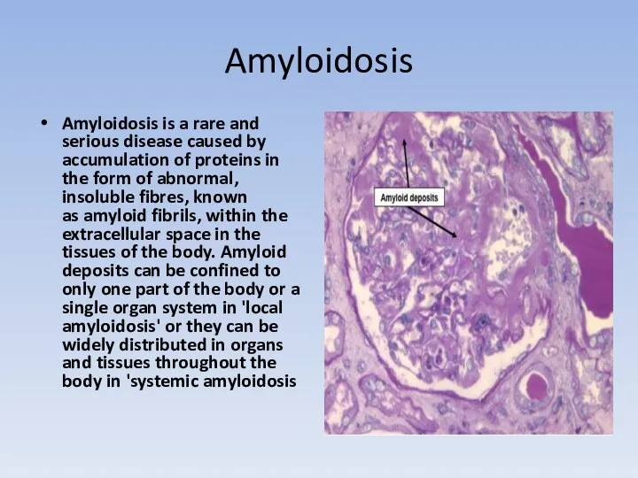 Amyloidosis Amyloidosis is a rare and serious disease caused by