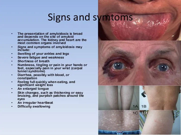 Signs and symtoms The presentation of amyloidosis is broad and