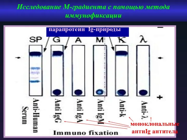 Исследование М-градиента с помощью метода иммунофиксации моноклональные антиIg антитела парапротеин Ig-природы