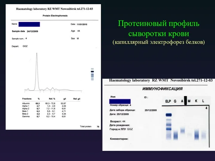 Протеиновый профиль сыворотки крови (капиллярный электрофорез белков)