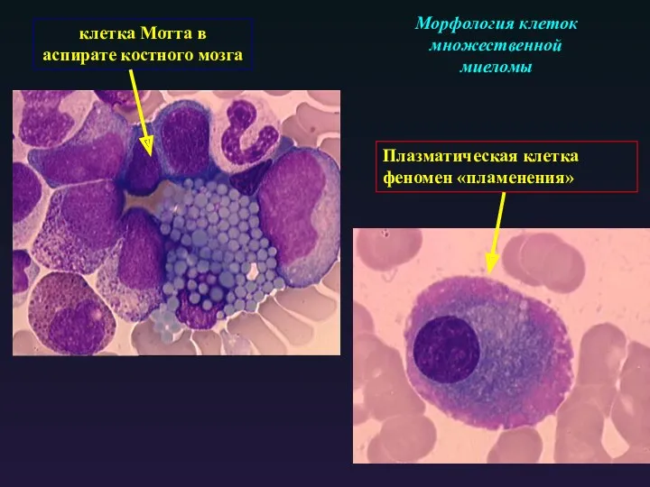 клетка Мотта в аспирате костного мозга Плазматическая клетка феномен «пламенения» Морфология клеток множественной миеломы