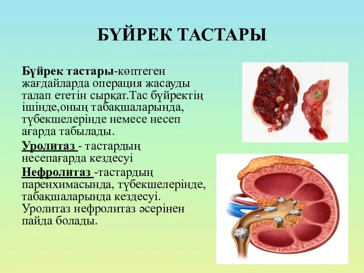 БҮЙРЕК ТАСТАРЫ Бүйрек тастары-көптеген жағдайларда операция жасауды талап ететін сырқат.Тас