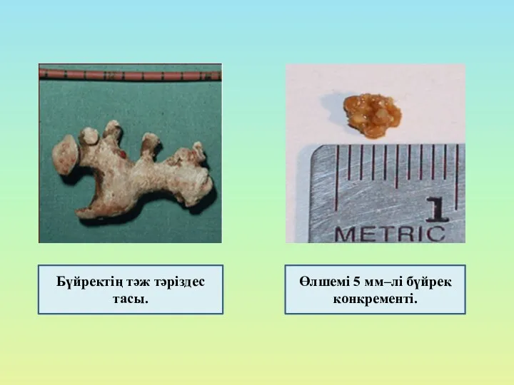 Бүйректің тәж тәріздес тасы. Өлшемі 5 мм–лі бүйрек конкременті.