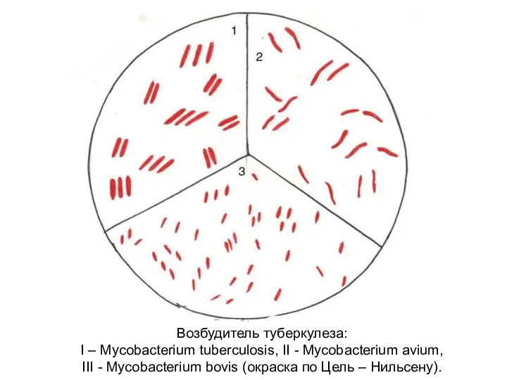 Возбудитель туберкулеза: I – Mycobacterium tuberculosis, II - Mycobacterium avium,