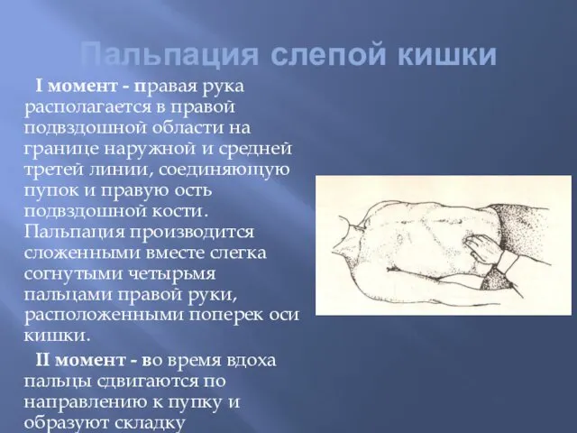 Пальпация слепой кишки I момент - правая рука располагается в