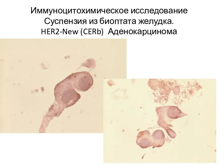 Иммуноцитохимическое исследование Суспензия из биоптата желудка. HER2-New (CERb) Аденокарцинома