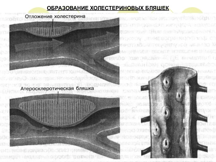 ОБРАЗОВАНИЕ ХОЛЕСТЕРИНОВЫХ БЛЯШЕК