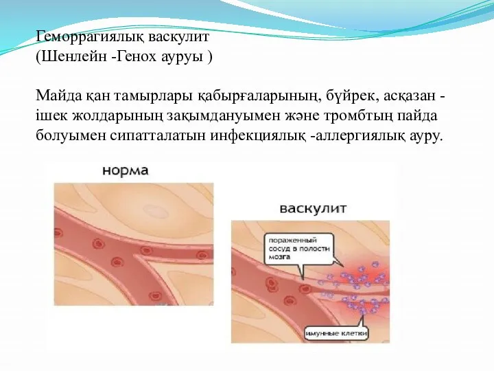 Геморрагиялық васкулит (Шенлейн -Генох ауруы ) Майда қан тамырлары қабырғаларының,