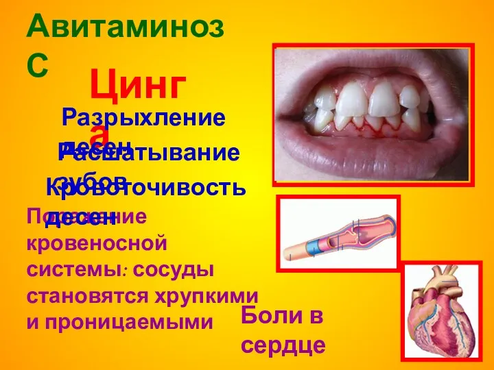 Авитаминоз С Цинга Разрыхление десен Расшатывание зубов Поражение кровеносной системы:
