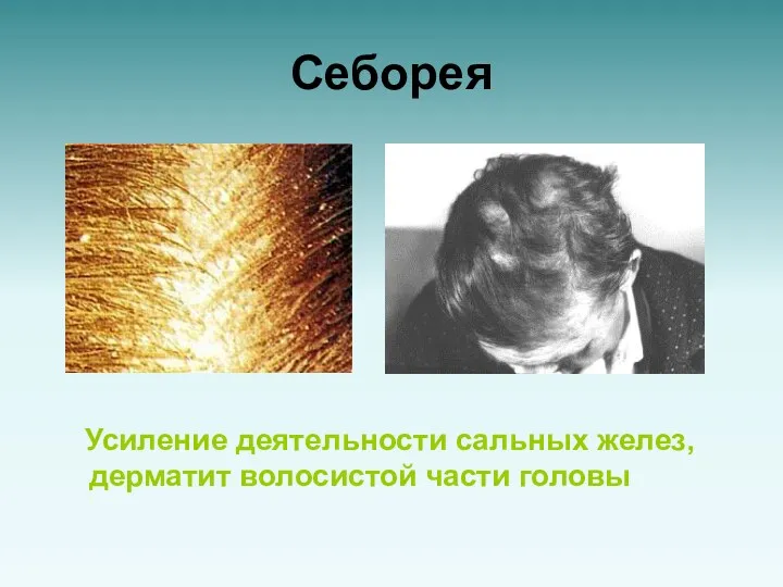 Себорея Усиление деятельности сальных желез, дерматит волосистой части головы