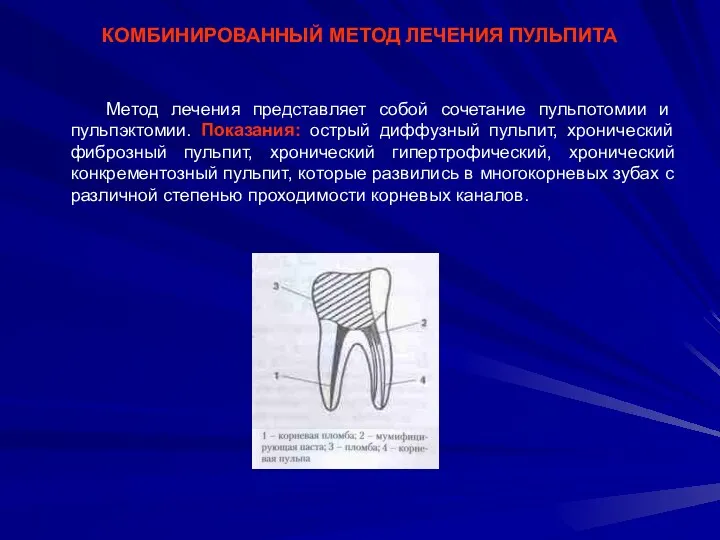 КОМБИНИРОВАННЫЙ МЕТОД ЛЕЧЕНИЯ ПУЛЬПИТА Метод лечения представляет собой сочетание пульпотомии и пульпэктомии. Показания: