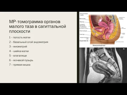 МР-томограмма органов малого таза в сагиттальной плоскости 1 – полость матки 2 –