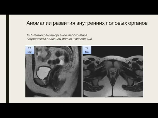 Аномалии развития внутренних половых органов МР- томограмма органов малого таза пациентки с аплазией матки и влагалища