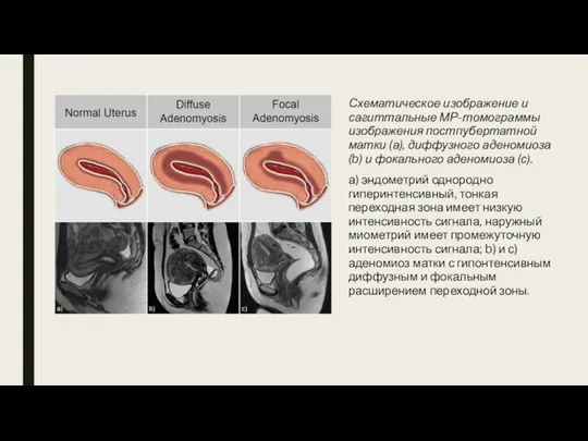 Схематическое изображение и сагиттальные МР-томограммы изображения постпубертатной матки (а), диффузного аденомиоза (b) и