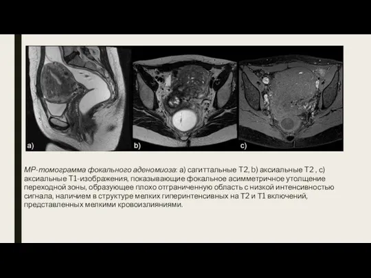МР-томограмма фокального аденомиоза: а) сагиттальные T2, b) аксиальные T2 , с) аксиальные T1-изображения,