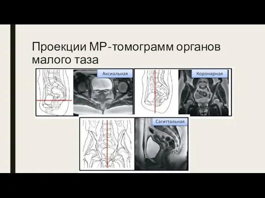 Проекции МР-томограмм органов малого таза