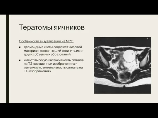 Тератомы яичников Особенности визуализации на МРТ: дермоидные кисты содержат жировой материал, позволяющий отличить