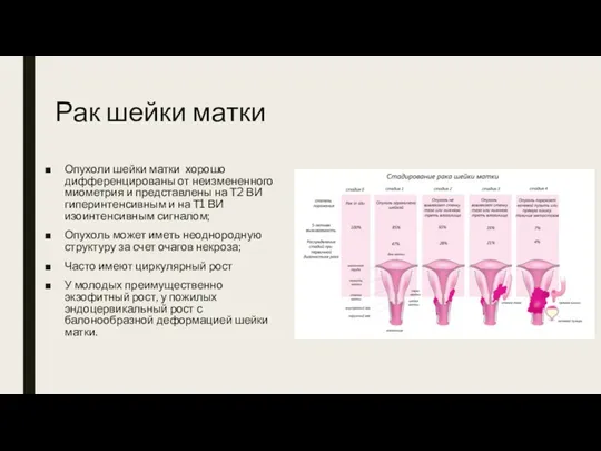 Рак шейки матки Опухоли шейки матки хорошо дифференцированы от неизмененного миометрия и представлены