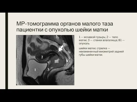 МР-томограмма органов малого таза пациентки с опухолью шейки матки 1 — мочевой пузырь;