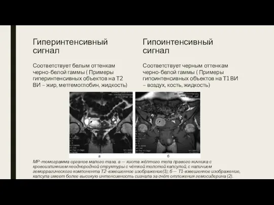 МР-томограмма органов малого таза. а — киста жёлтого тела правого яичника с кровоизлиянием