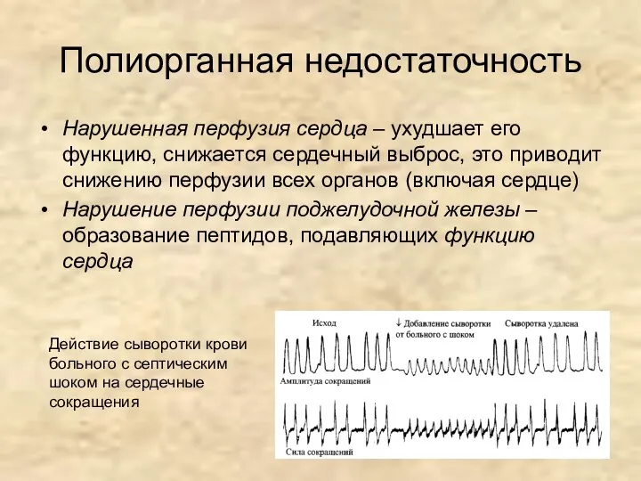 Полиорганная недостаточность Нарушенная перфузия сердца – ухудшает его функцию, снижается