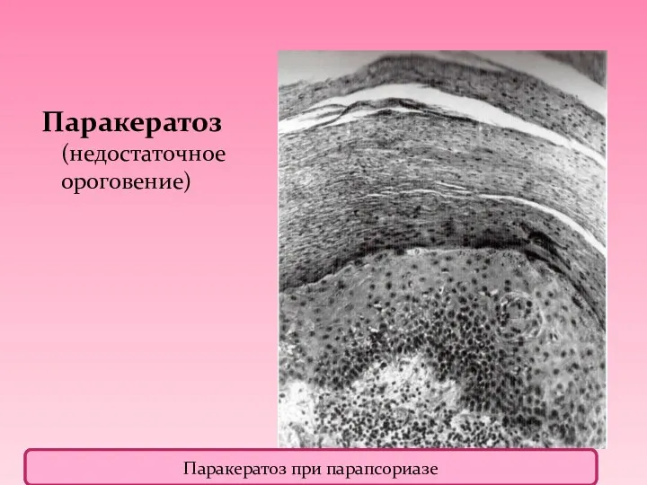 Паракератоз (недостаточное ороговение) Паракератоз при парапсориазе Паракератоз при парапсориазе