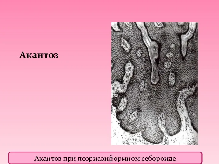 Акантоз Акантоз при псориазиформном себороиде