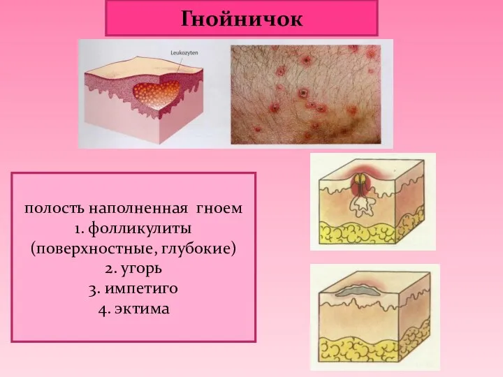 Гнойничок полость наполненная гноем 1. фолликулиты (поверхностные, глубокие) 2. угорь 3. импетиго 4. эктима