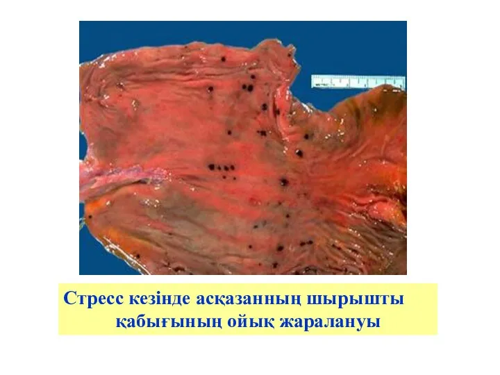 Стресс кезінде асқазанның шырышты қабығының ойық жаралануы