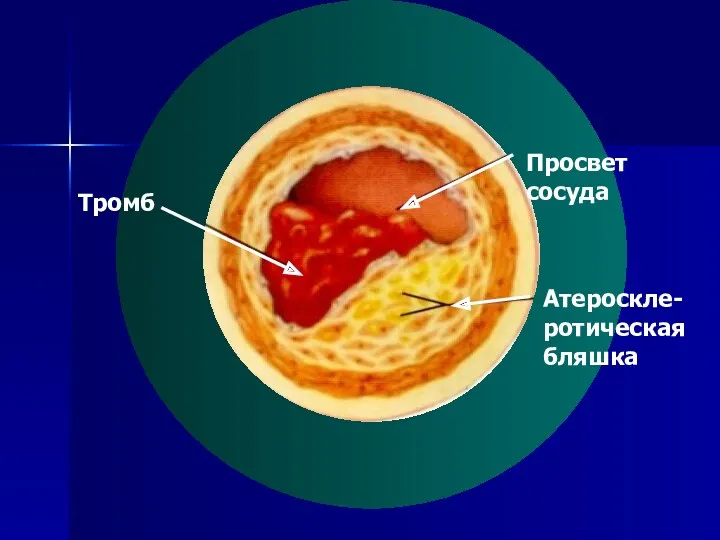 Просвет сосуда Атероскле-ротическая бляшка Тромб