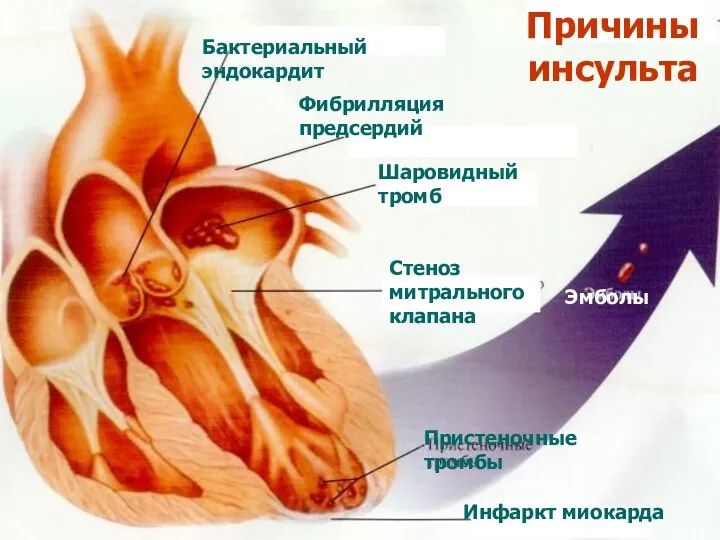 Причины инсульта Бактериальный эндокардит Фибрилляция предсердий Шаровидный тромб Стеноз митрального клапана Пристеночные тромбы Эмболы Инфаркт миокарда