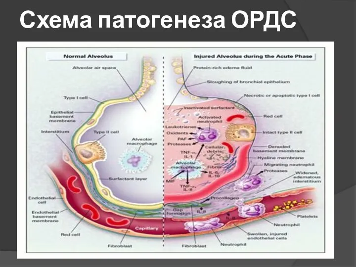 Схема патогенеза ОРДС