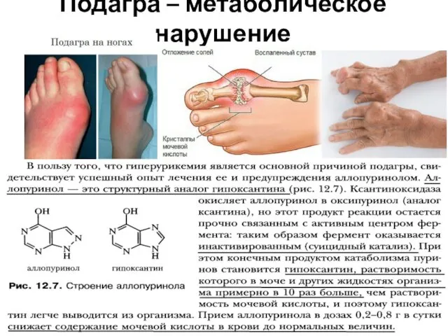 Подагра – метаболическое нарушение