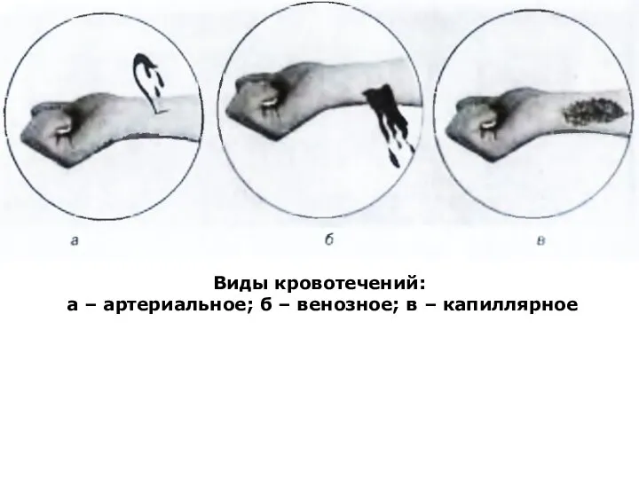 Виды кровотечений: а – артериальное; б – венозное; в – капиллярное