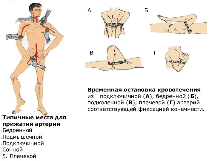 Типичные места для прижатия артерии Бедренной Подмышечной Подключичной Сонной 5.