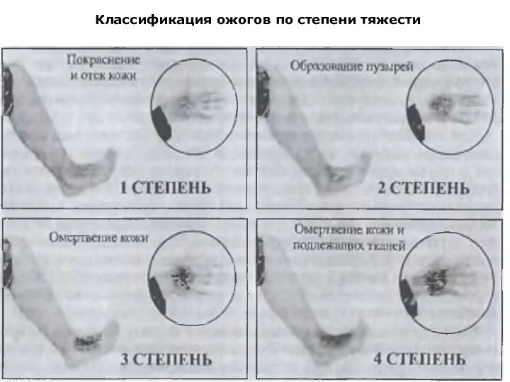 Классификация ожогов по степени тяжести