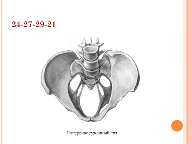 24-27-29-21 Поперечносуженный таз