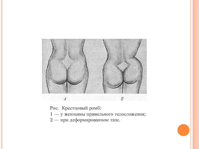Рис. Крестцовый ромб: 1 — у женщины правильного телосложения; 2 — при деформированном тазе.